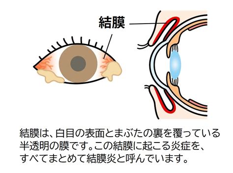 慢性結膜炎|結膜炎について